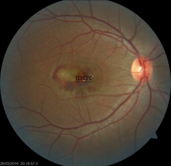 Age Related Macular Degeneration- ARMD-retina specialist in mumbai - mumbai eye retina clinic
