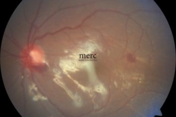 giant-retinal-tear-after-surgery-retina specialist in mumbai - mumbai eye retina clinic