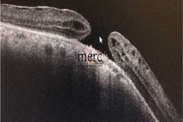macular hole before surgery - mumbaieyeretinaclinic.com