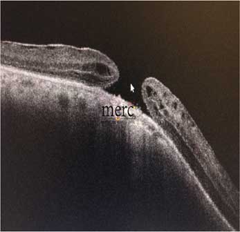 macular hole before surgery - mumbaieyeretinaclinic.com