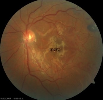 retina detachment surgery with keratoconus