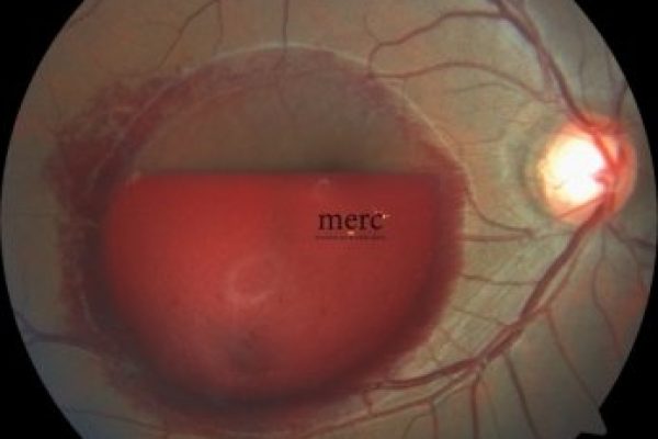 retinal laser - before-retina specialist in mumbai - mumbai eye retina clinic