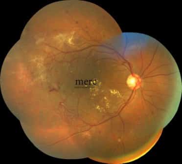 cost of retina surgery