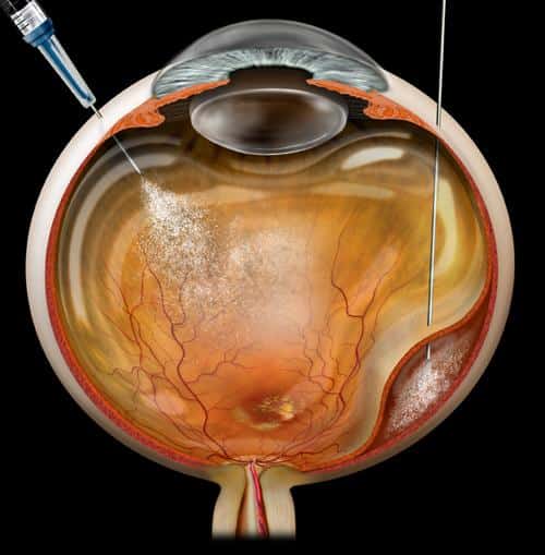 mistat injection to the eye