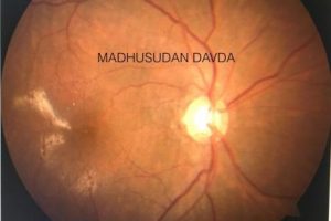retinal tear - retina specialist in mumbai - mumbai eye retina clinic