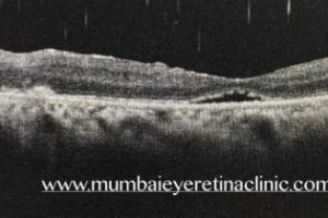 retina specialist in mumbai - mumbai eye retina clinic