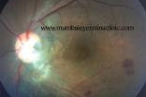 retina specialist in mumbai - mumbai eye retina clinic