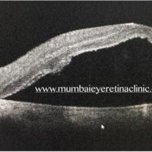 retina specialist in mumbai - mumbai eye retina clinic