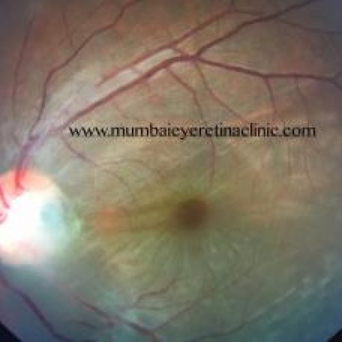 retina specialist in mumbai - mumbai eye retina clinic