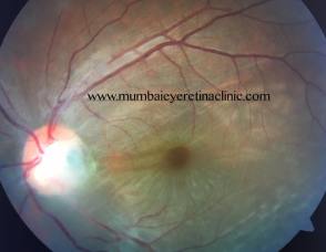 retina specialist in mumbai - mumbai eye retina clinic