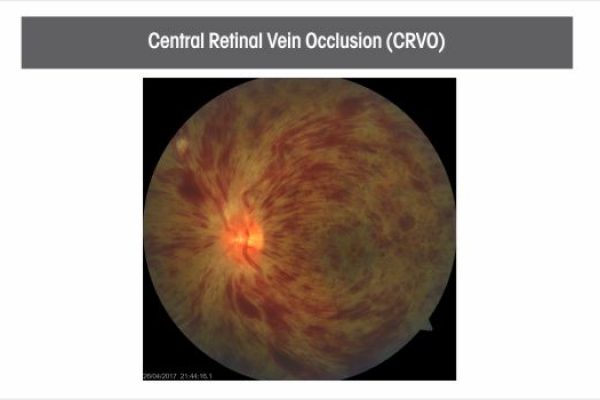 central-retinal-vein-occlusion(crvo)