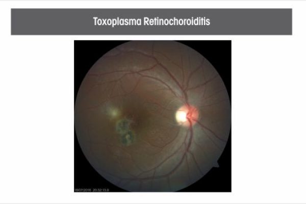 toxoplasma-retinochoroiditis