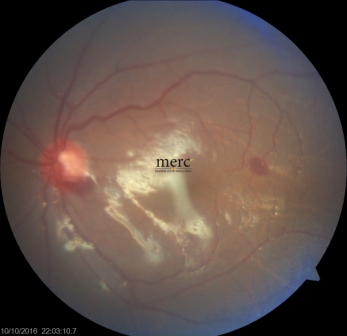 giant-retinal-tear-after-surgery