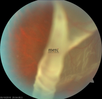 giant-retinal-tear-before-surgery